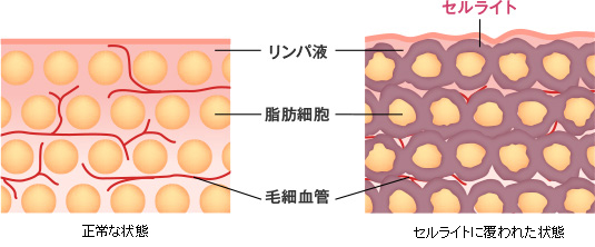 セルライトとは