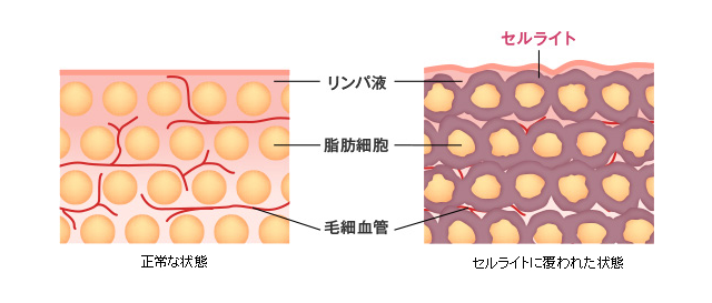 セルライトイメージ