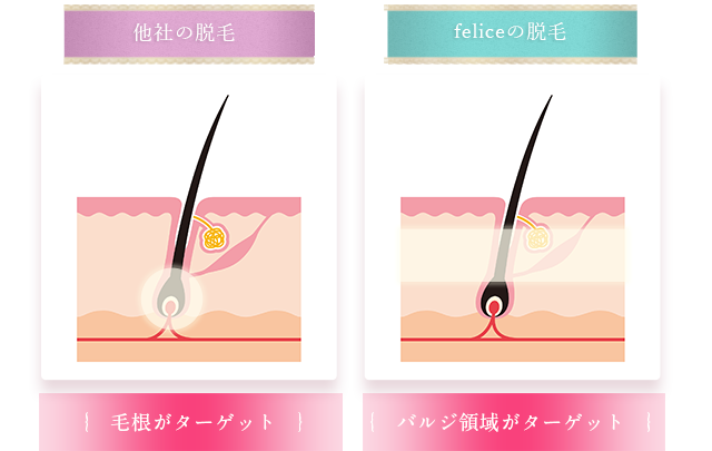 従来の脱毛・RIOXYの脱毛